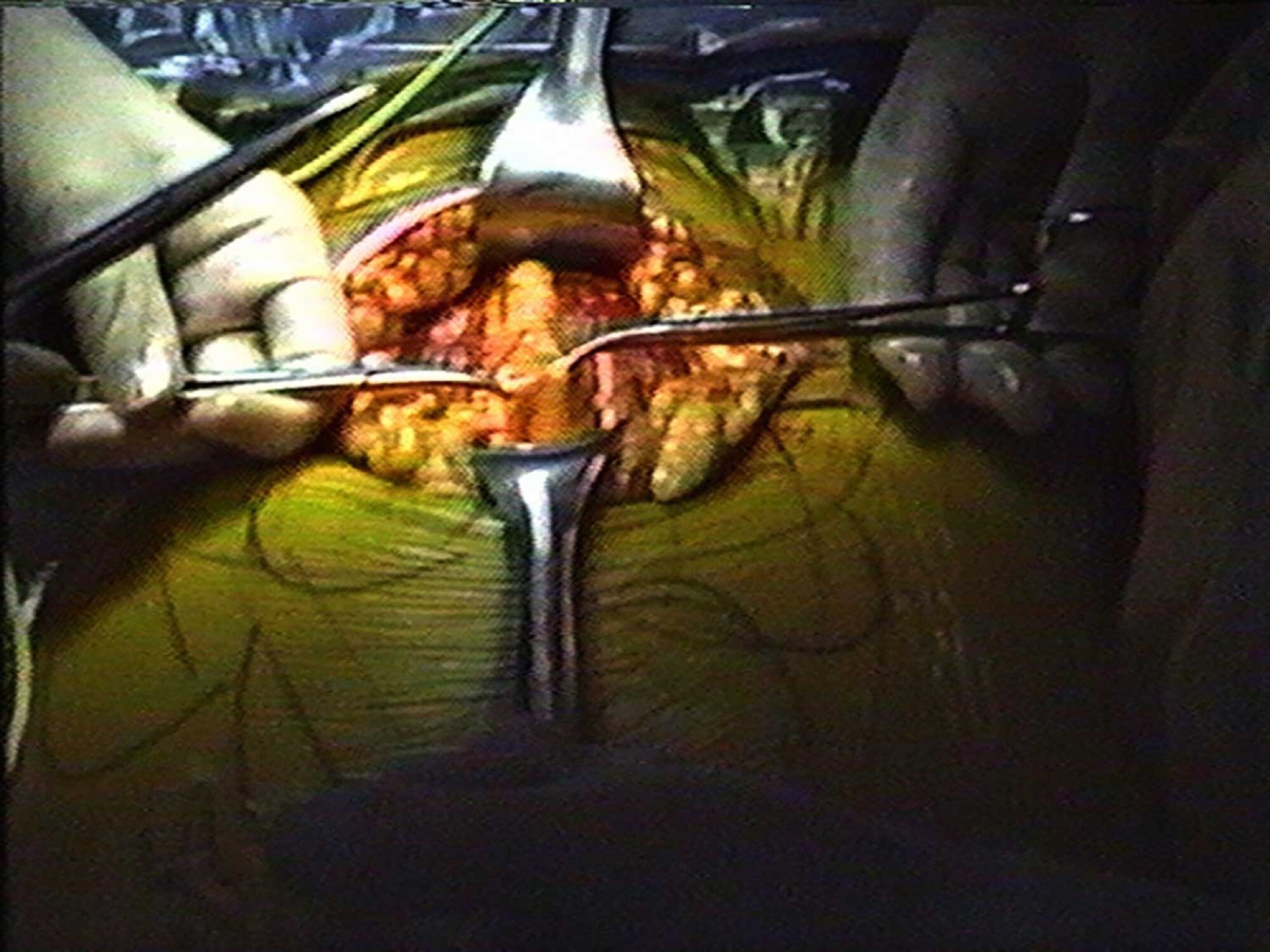 <p>Lutz Bacher, <em>Huge Uterus</em>, 1989, 6:00:00 VHS and audio tape loop. Image: <a href="https://flash---art.com/article/everyday-instability/"><a href="https://flash---art.com/article/everyday-instability/">https://flash—-art.com/article/everyday-instability/</a></a></p>